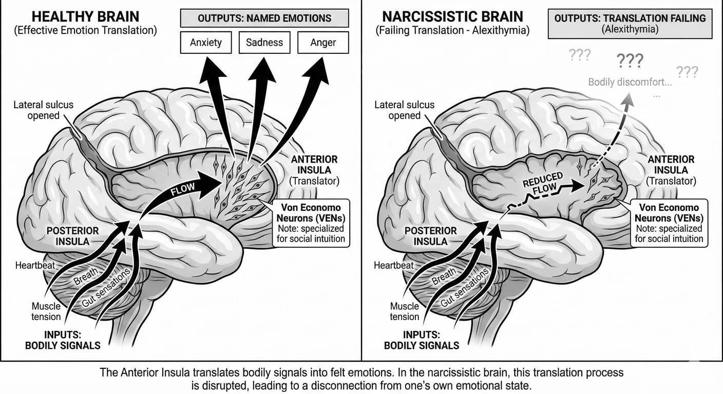 The Translator—anterior insula body-to-mind translation failure. In healthy brains (left), body sign